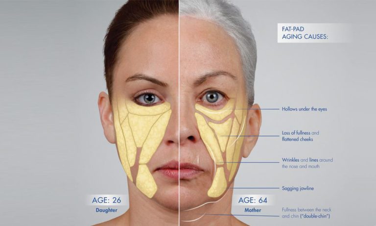 chart of fat-pad aging causes