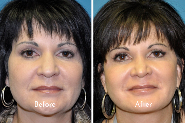 facelift before and after