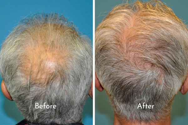 hair restoration before and after