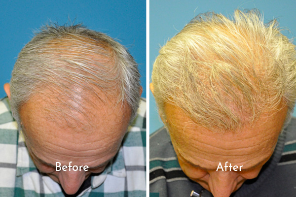 hair restoration before and after