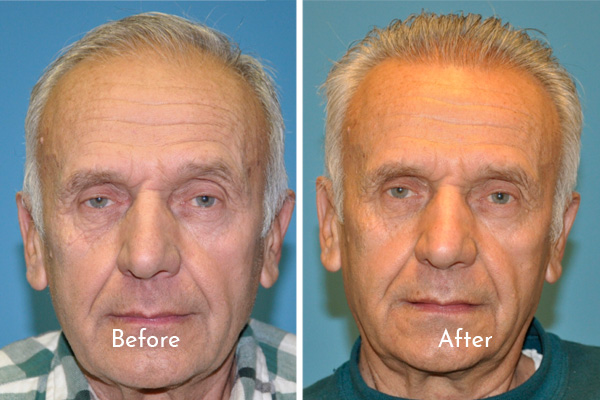 hair restoration before and after