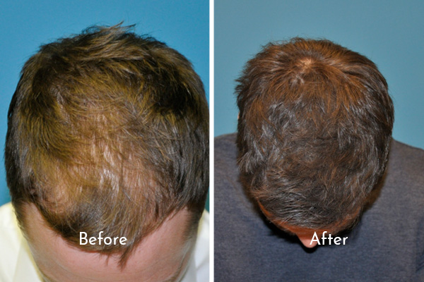 hair restoration before and after